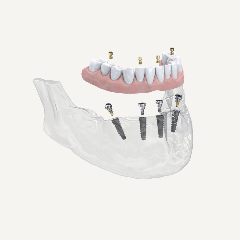 Access Abutments